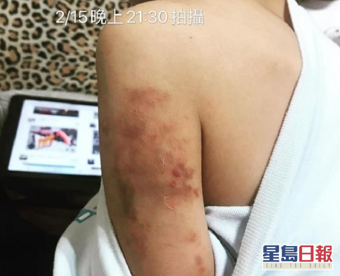被虐学童手上瘀青相当明显。网上图片
