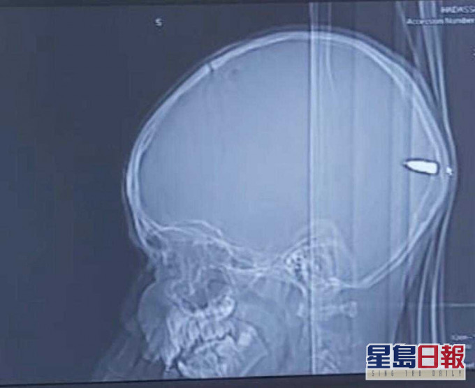 求醫才發現男童腦後顱骨位置卡住一顆子彈。網圖