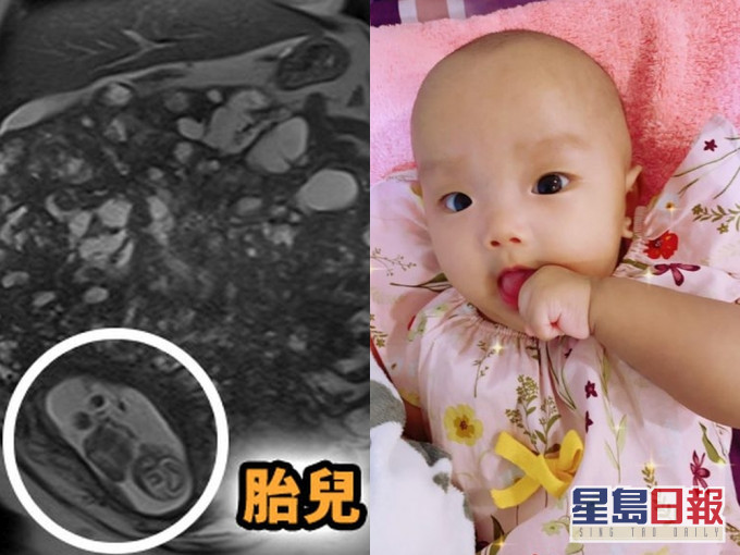 台灣一名孕媽子宮長巨型肌瘤塞滿全腹,更曾懷疑是惡性腫瘤,但她堅持捱至35週剖腹產,幸母子平安。(網圖)
