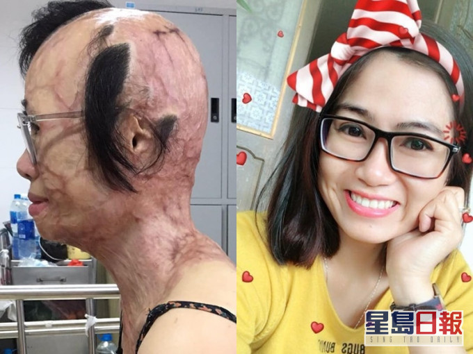 Huyen经历21次手术重拾美貌。网上图片