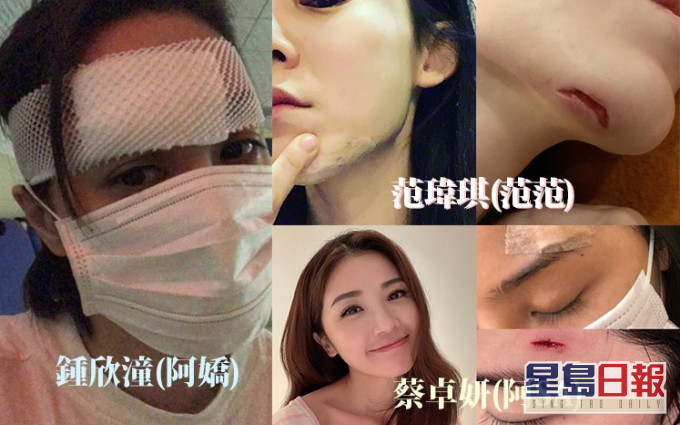 藝人最想係走紅,最怕係見紅,不少藝人都試過意外受傷見紅,一齊回顧一吓並引以為戒。