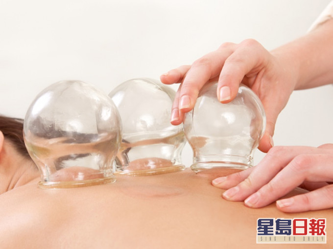 拔罐除了可以去濕,還可以拉鬆肌肉,適合肌肉疲勞及頸累的人士。網上圖片