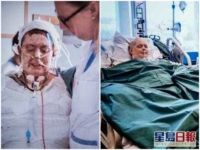瑞典一名妈妈Emma Schols在一场大火中,以一人之躯救出自己6名子女,但换来全身93%皮肤烧伤。网图