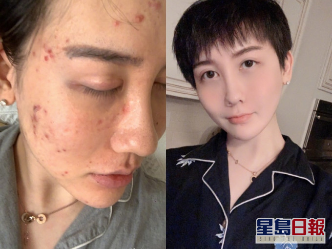 刘梓晨指自己突然消失因为毁容。网图