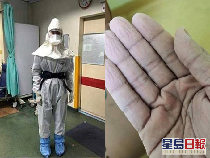 原po上載全副保護衣及手套脫下後雙手發白起皺的照片。fb