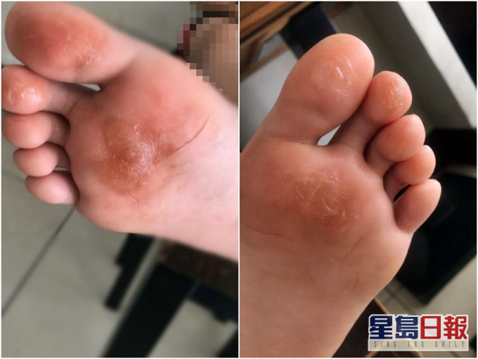 多名學生的腳底起水泡,甚至破皮流血。網圖