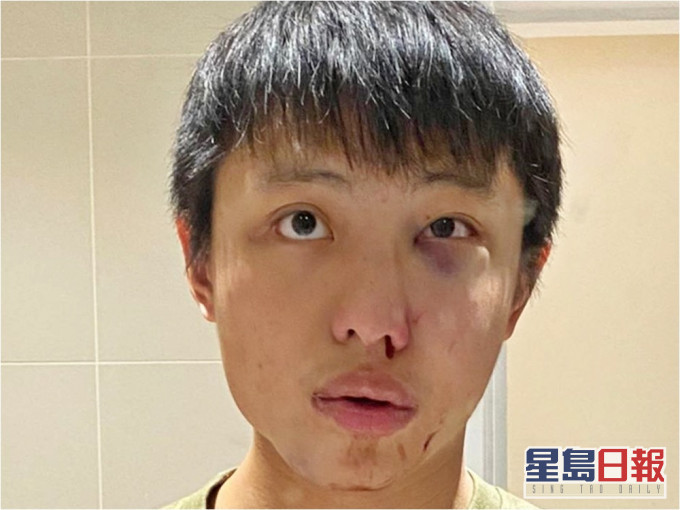 新加坡留學生莫顯強（Jonathan Mok）去年因疫情歧視遭毆打。網圖