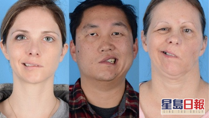 貝爾氏麻痹症(Bell's palsy)網上示意圖片