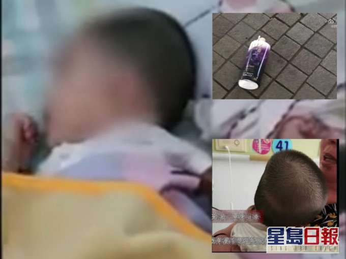 6個月大女嬰遭樓上洗頭水砸中,頭骨骨折未脫離危險期。影片截圖