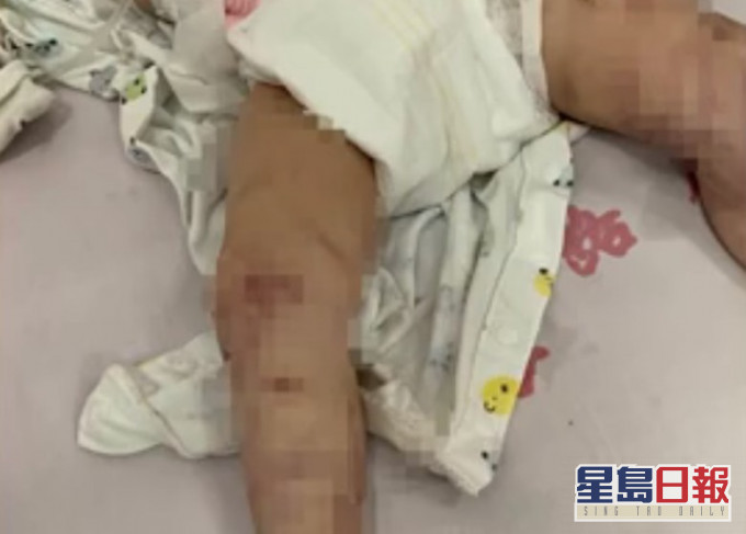 黄男童遭亲生母亲虐打,满身伤痕,被送入深切治疗部抢救。网图
