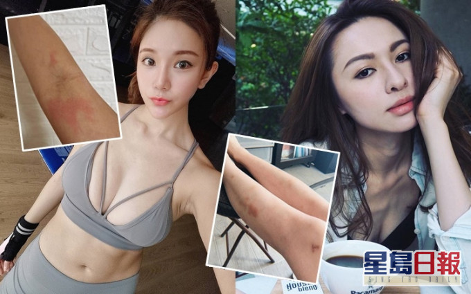 Denice和Toto參加ViuTV靈探比賽真人騷《鬼同妳上位》都搞到周身傷。