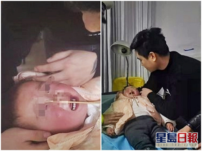 女童的鼻翼被竹籤貫穿。網圖