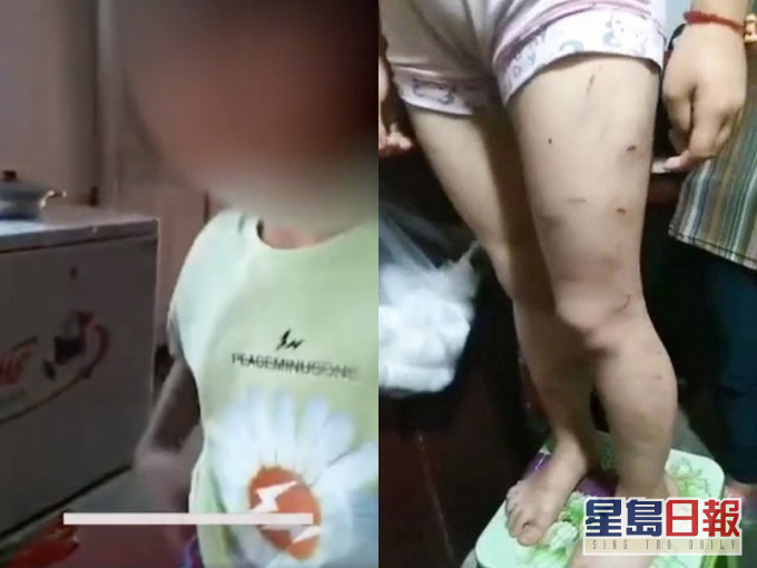 女童疑被父母長期施暴。網圖