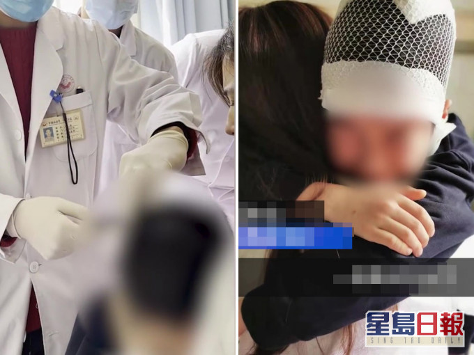 9歲男童被老師扯頭髮拖行致頭皮頭骨分離。