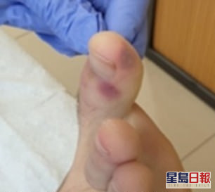 一些新冠肺炎患者的腳上出現了「類似水痘或麻疹」的病變。(網圖)