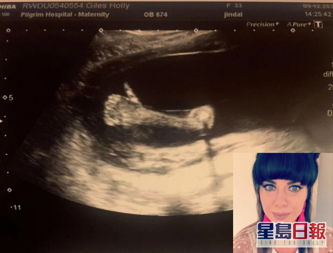 英國一名孕婦照B超驚見男嬰肚內豎大姆指。(網圖)