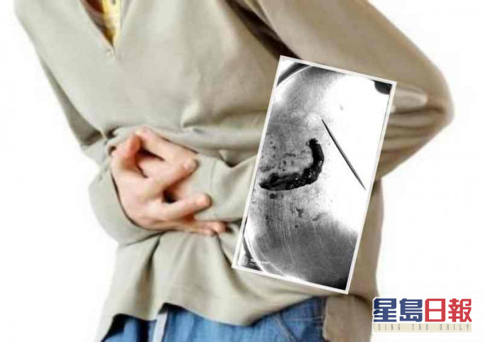 經了解,這3名病人都是在酒後誤吞牙籤。網圖