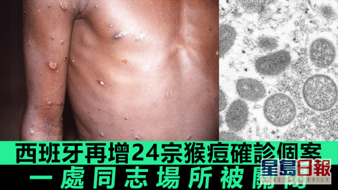 西班牙迄今有30宗猴痘个案。美联社图片