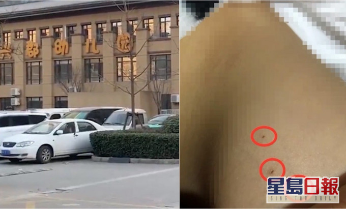 内地一名3岁女童放学后被母亲发现身上有疑似针孔。网图