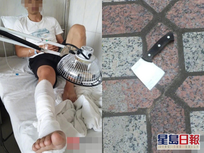 男子被菜刀砍傷右小腿,右脛前肌腱斷裂。網圖