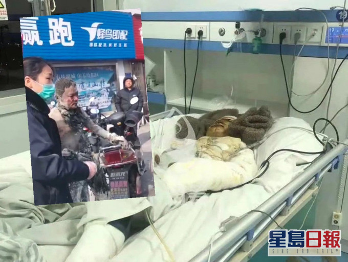 外卖员刘进全身烧伤面积达8成。网图