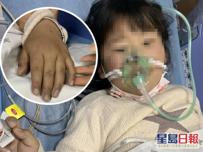 女童嘴唇和指甲發紫。網圖