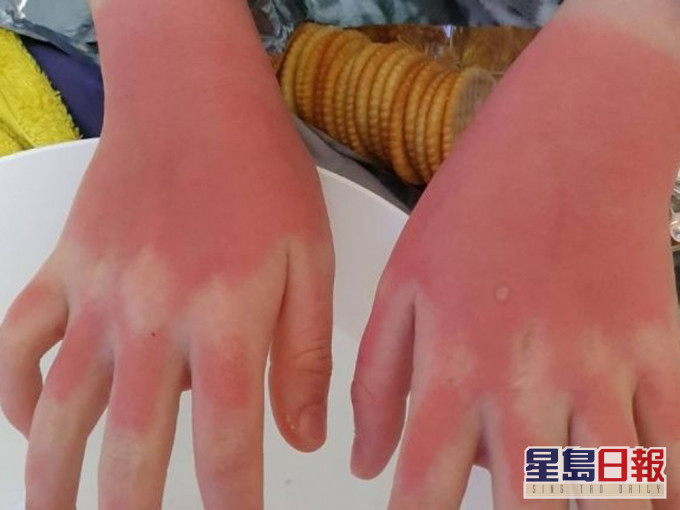 12岁女参加完学校的水上活动日后,双手被晒伤,非常红烫。