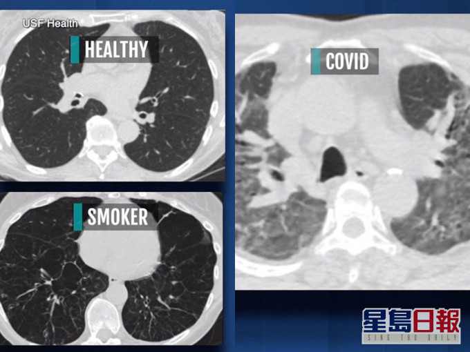 有医生指新冠患者肺部伤疤比吸烟严重，包括无症状患者。
