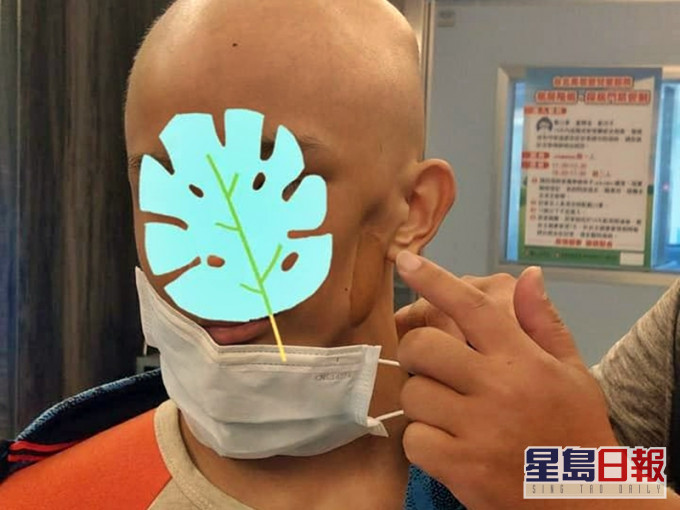 台湾一名姓许的单亲爸爸,其14岁的儿子曾经患癌,并曾3度复发,左半部牙龈及牙齿都被癌细胞啃噬,只能将左边脸削去大半才能保命。网图