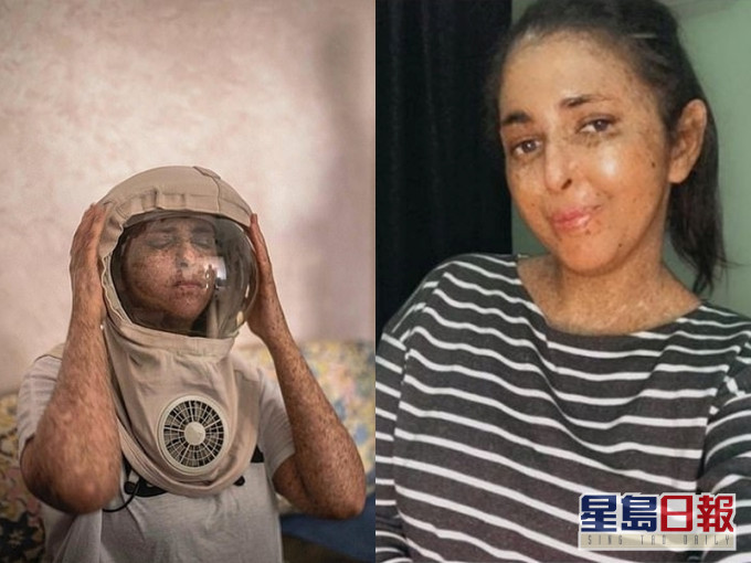 英国一名女子患上罕见疾病,对阳光过敏,外出须戴「太空面罩」。(网图)
