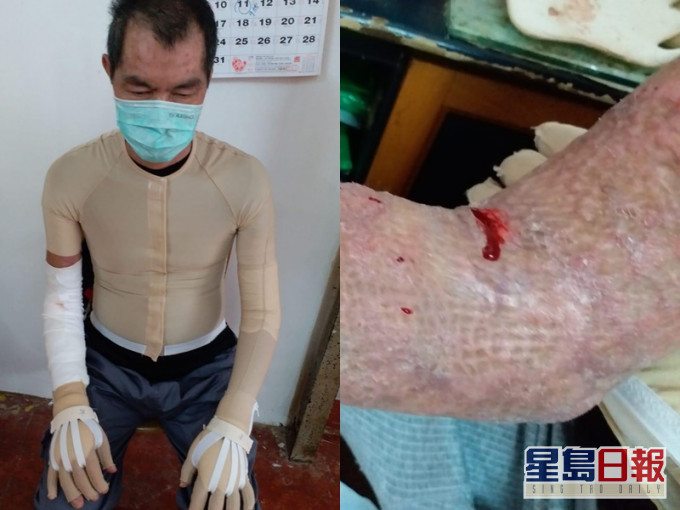 葛珮帆指李生皮膚經常起水泡及流血。