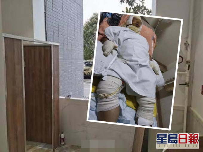 男子全身大面積燒傷病情危重。網圖