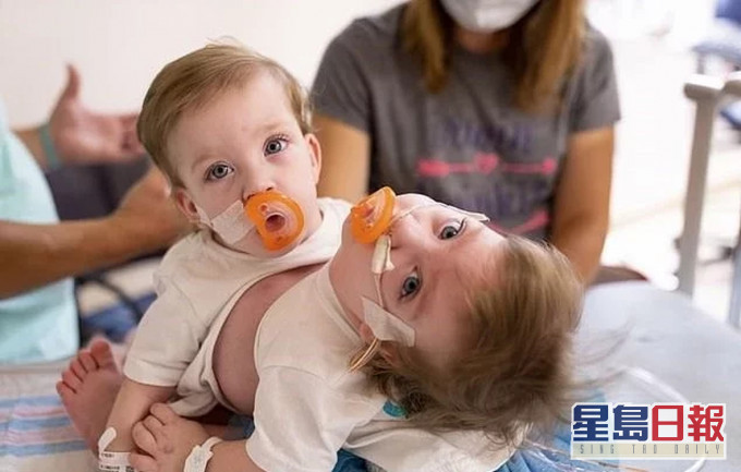 连体双胞胎女婴出生时由胸部至肚脐已经是相连的。AP图片