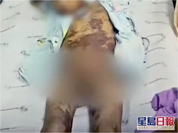 泰国男童被老师淋刺激性药水，导致全身被灼伤。网图