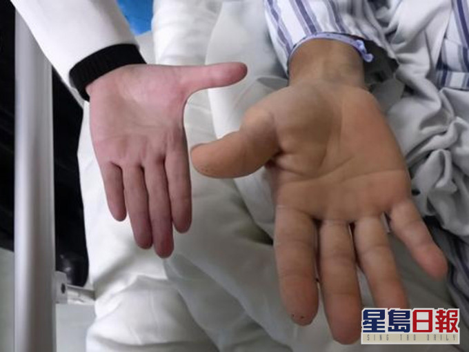 56岁男手掌变大两倍。(网图)