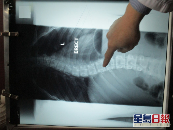 承辦商於為學生進行脊柱X光檢查時,未有將乳腺屏蔽裝置並放置在正確位置,亦未有使用生殖腺屏蔽裝置。資料圖片(示意圖)