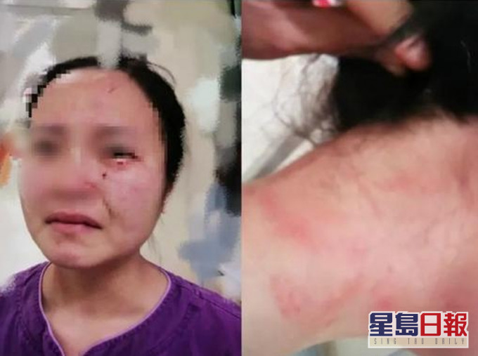 一名外籍新冠肺炎確診患者在廣州市第八人民醫院不配合治療、毆打並咬傷一名女護士。(網圖)