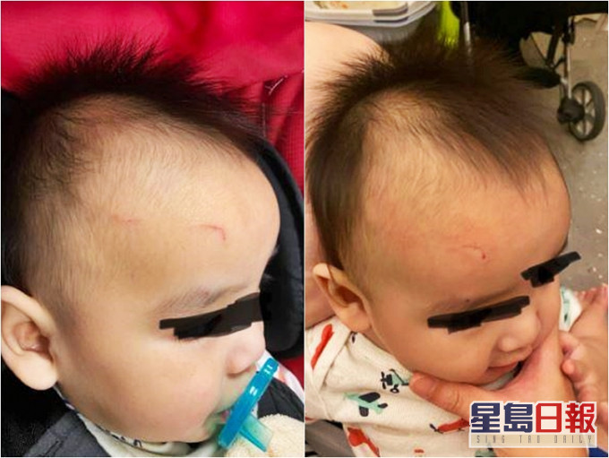8月大的婴儿脸部被床架铁件割伤。Facebook专页「爆料公社」图片