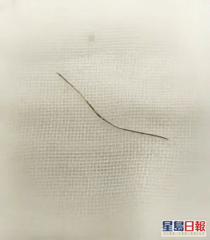 男子自行針灸治腰痛,結果10厘米長針斷體內,須手術取出。網上圖片
