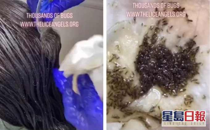 工作人员用梳刷出大量头虱。网上截图