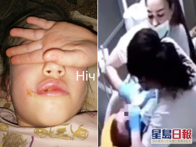 烏克蘭6歲女童睇牙醫後嘴巴異常腫脹,揭醫護曾虐待多名兒童。(網圖)