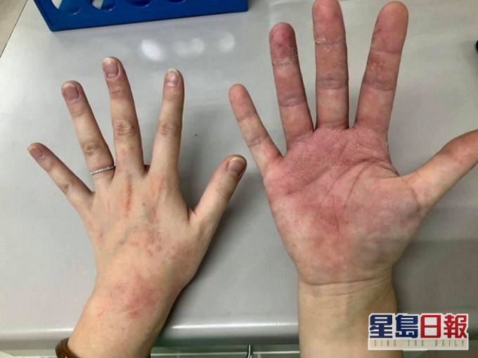 前線抗疫醫護人員雙手長時間戴手套脫皮起紅疹。