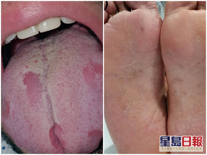 西班牙有研究團隊發現，確診者出現「新冠舌頭」病徵，手掌及腳掌均起紅點、出疹，甚至脫皮。網圖