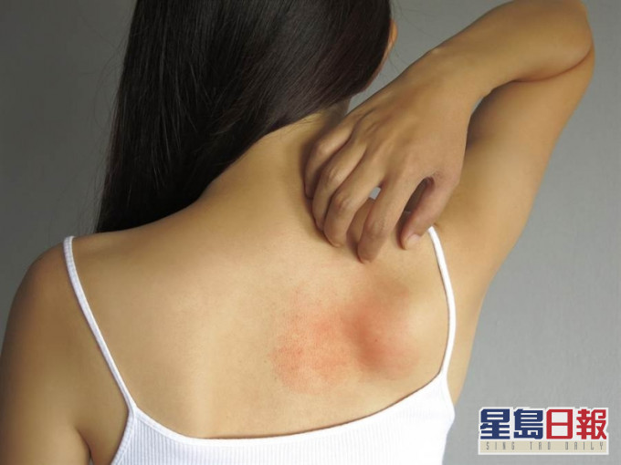 不論大人、小孩身上冒出一粒粒又熱又癢的痱子,都會感覺不舒服。
