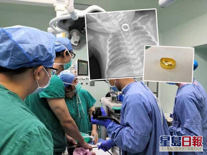廣東1歲女嬰誤吞金戒指卡食道,醫生用超細胃鏡拆彈。(網圖)