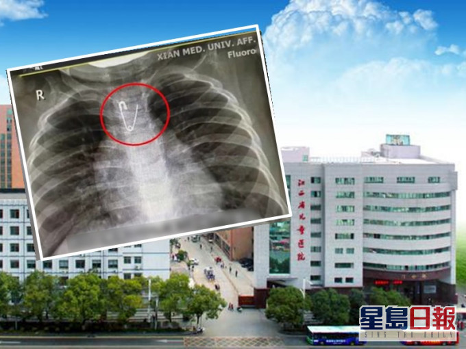 陝西西安上月亦曾發生有嬰兒吞下扣針事件。