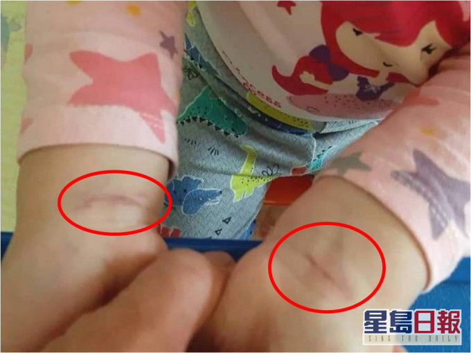 台南女童疑遭虐待，家人懷疑是幼稚園所為。網圖