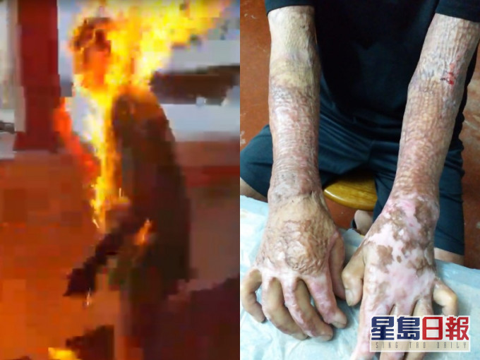 被火烧李生双手仍疼痛需要服止痛药。