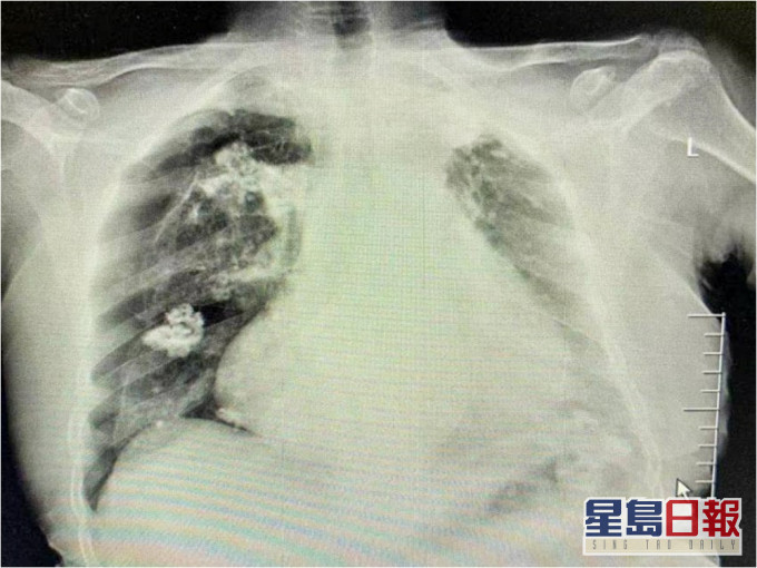 江苏妇在针灸时竟被扎穿肺,右肺被压缩了一半。网图