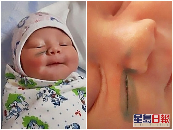 俄羅斯一名新手媽媽剖腹生產後,發現女兒的臉上有一道長約3厘米的傷口。網圖